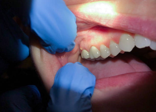 Best Emergency Treatment for Dental Infections or Abscesses in New Square, NY